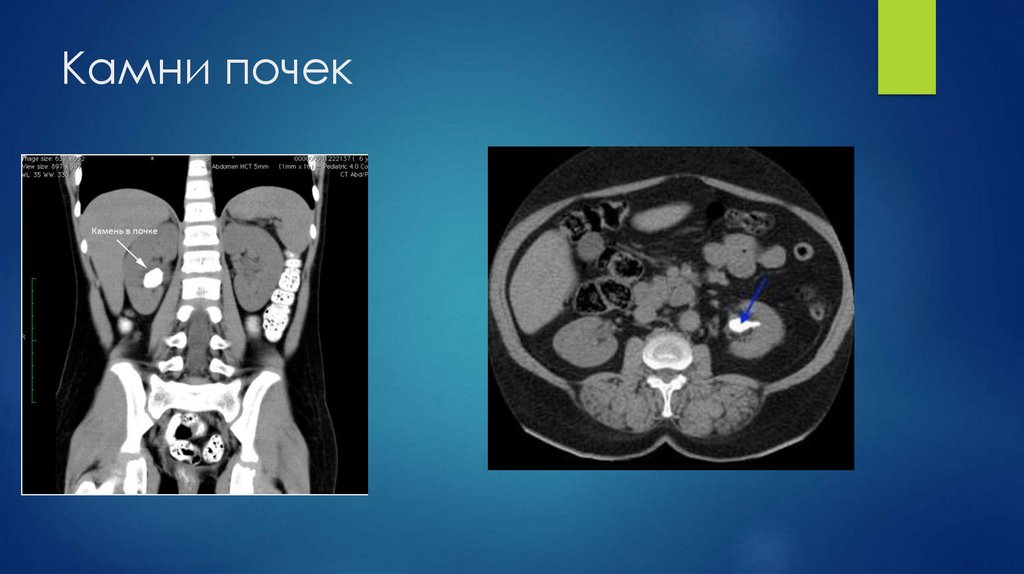 Камни почек