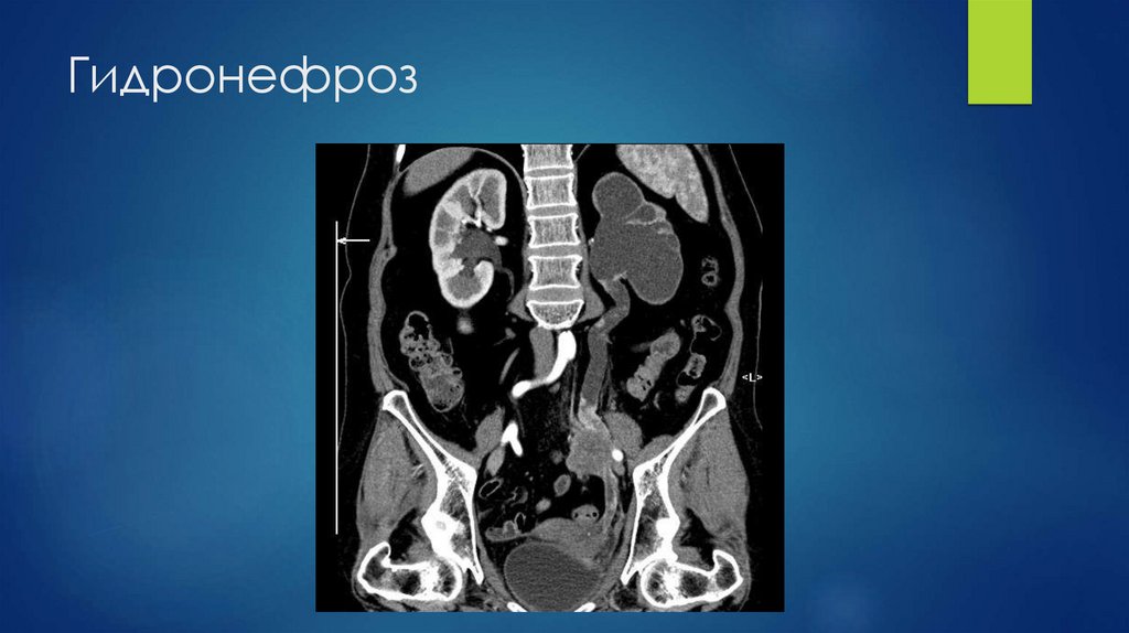 Гидронефроз