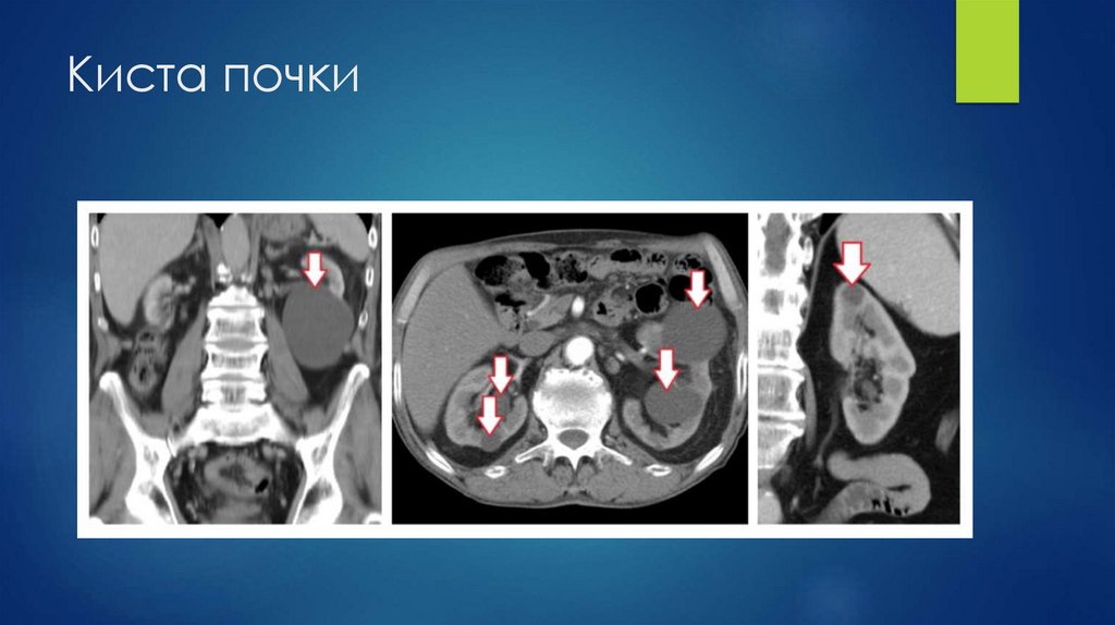 Киста почки