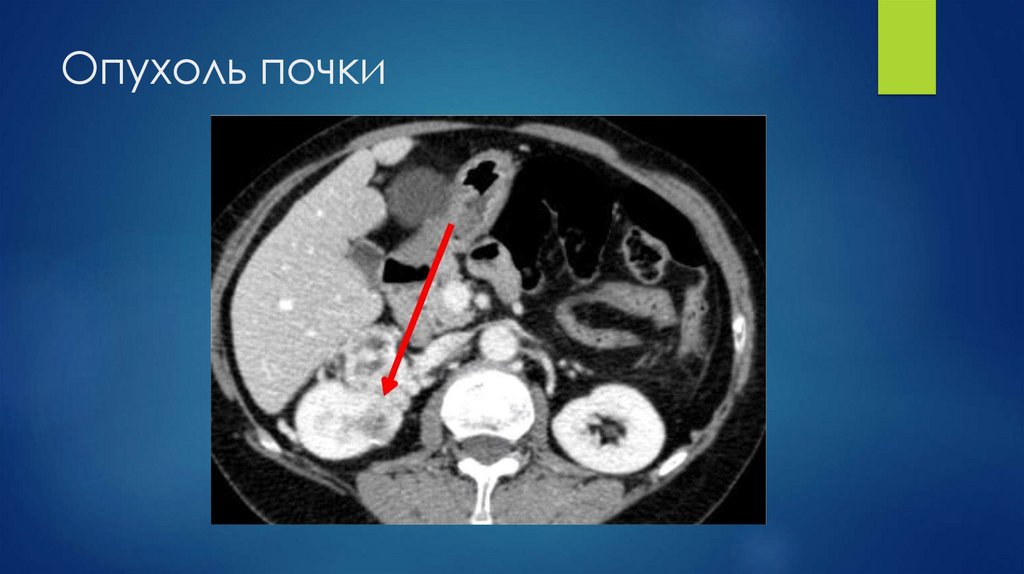Опухоль почки