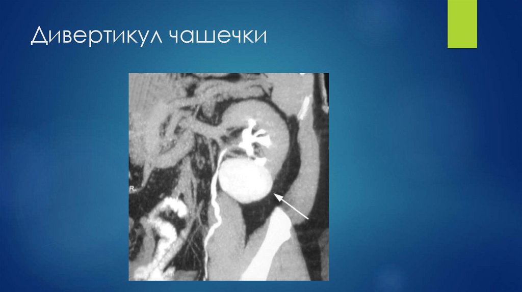 Дивертикул чашечки