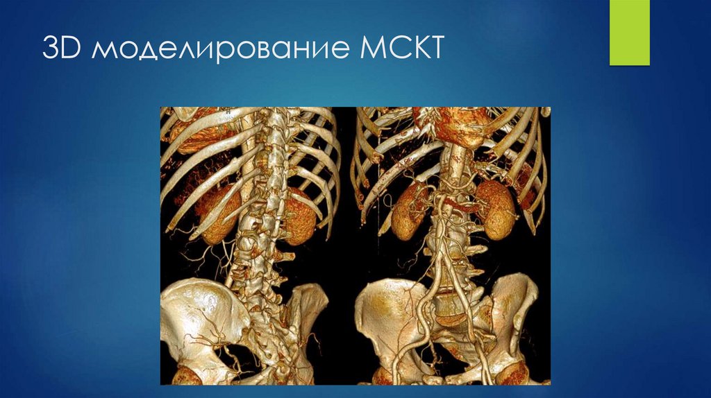 3D моделирование МСКТ