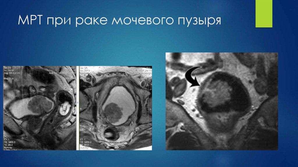 МРТ при раке мочевого пузыря