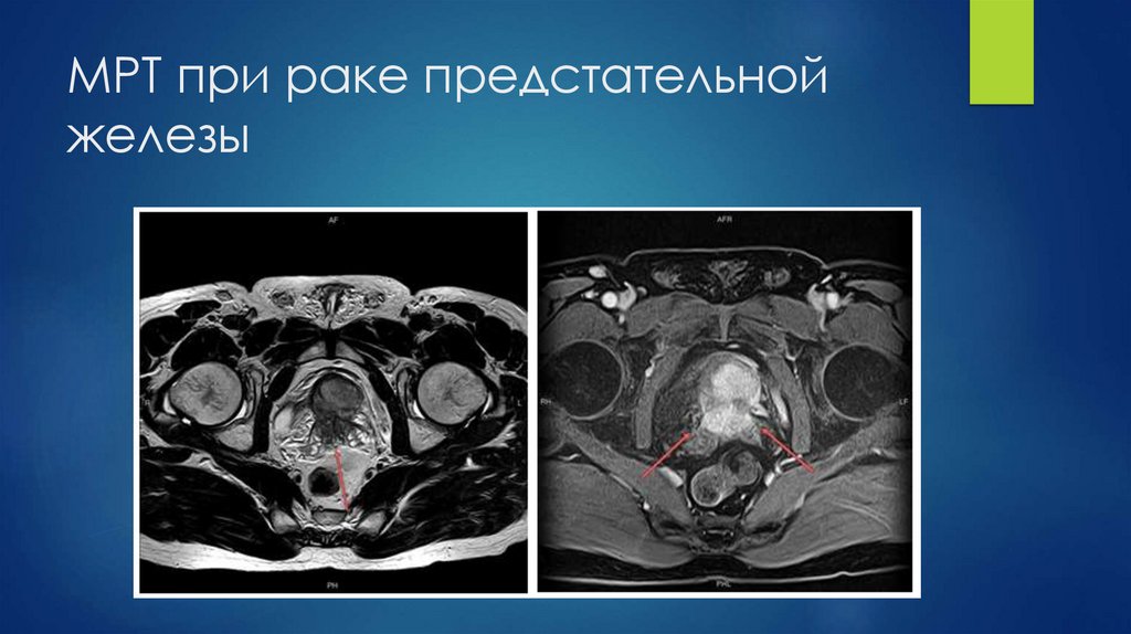 МРТ при раке предстательной железы
