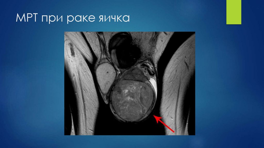 МРТ при раке яичка