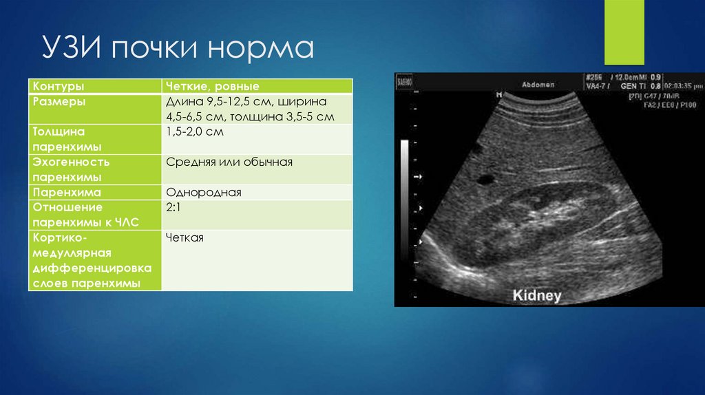 УЗИ почки норма