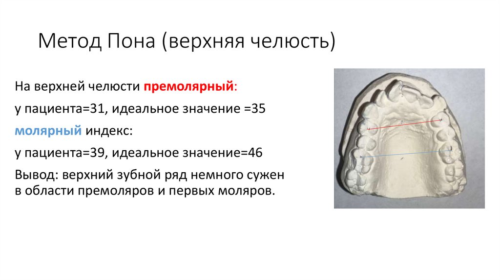 Метод Пона (верхняя челюсть)