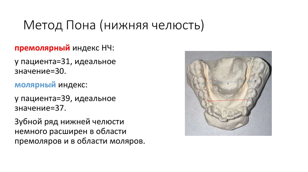 Метод Пона (нижняя челюсть)