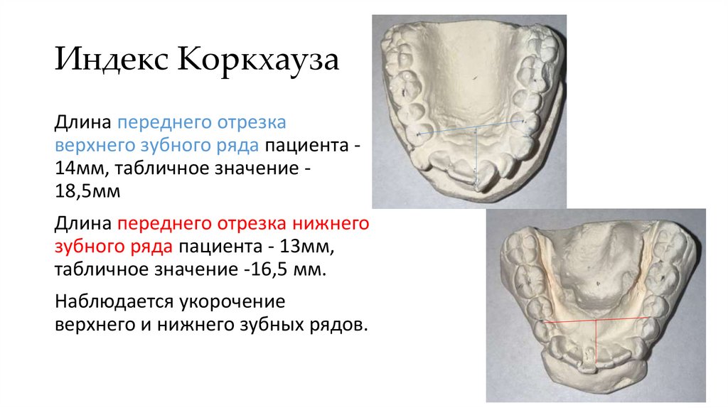 Индекс Коркхауза