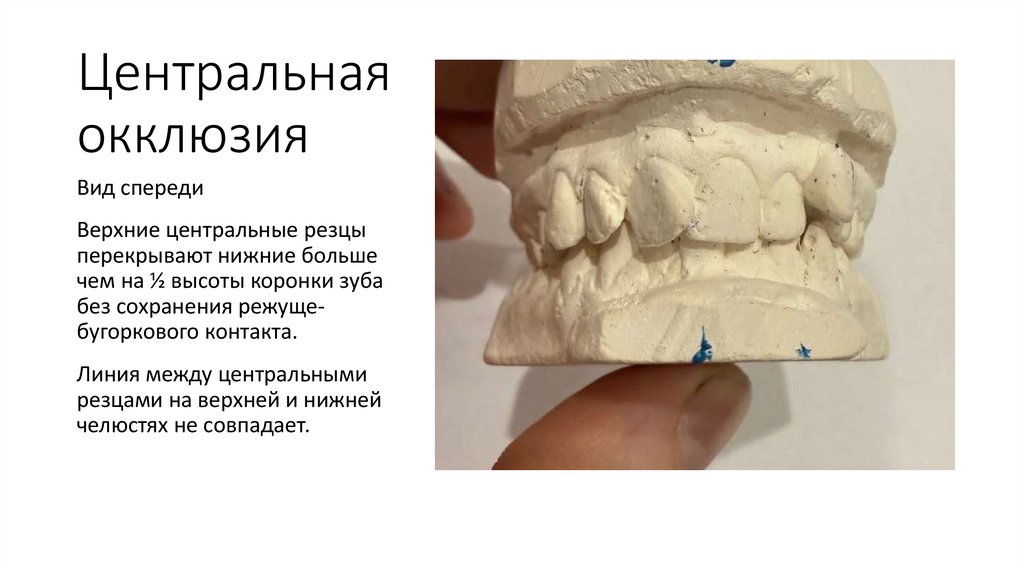 Центральная окклюзия