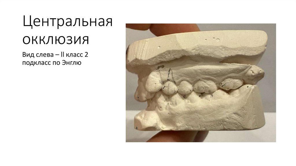 Центральная окклюзия