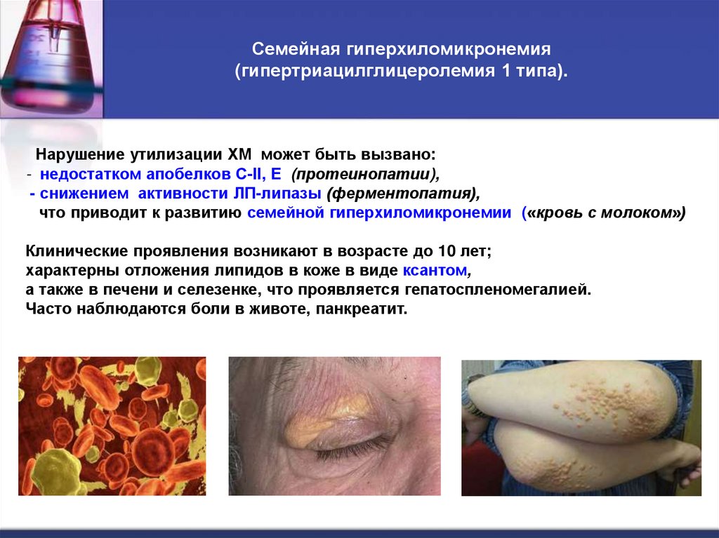 Семейная гиперхиломикронемия (гипертриацилглицеролемия 1 типа).