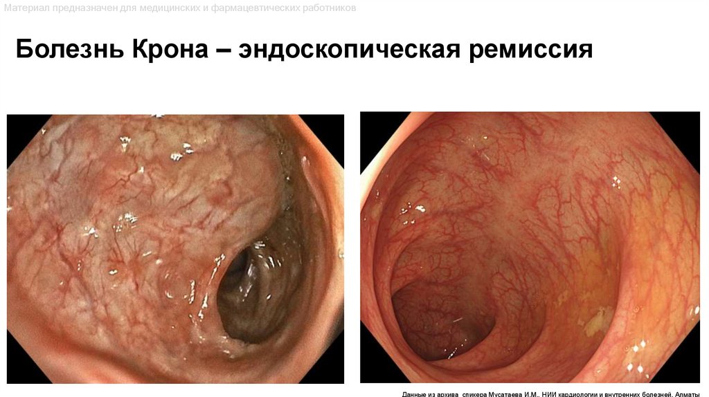 Болезнь Крона – эндоскопическая ремиссия