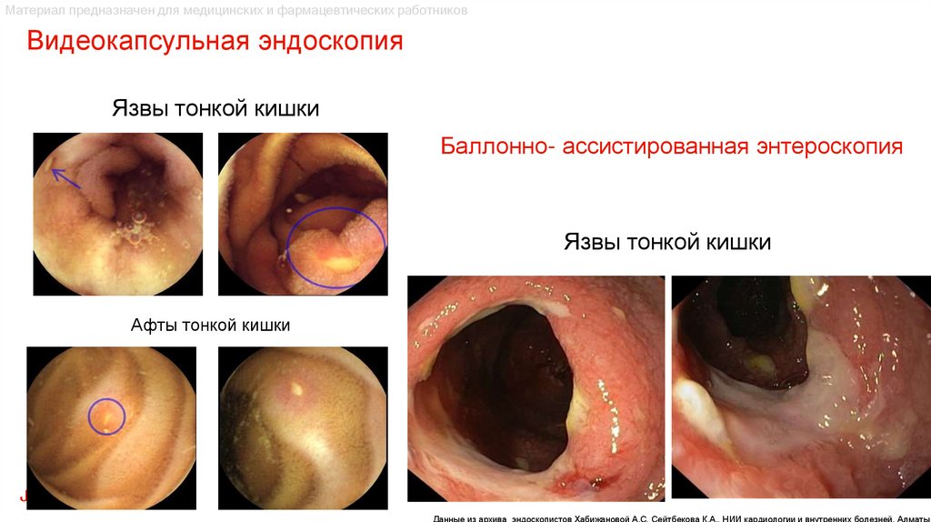 Язвы тонкой кишки