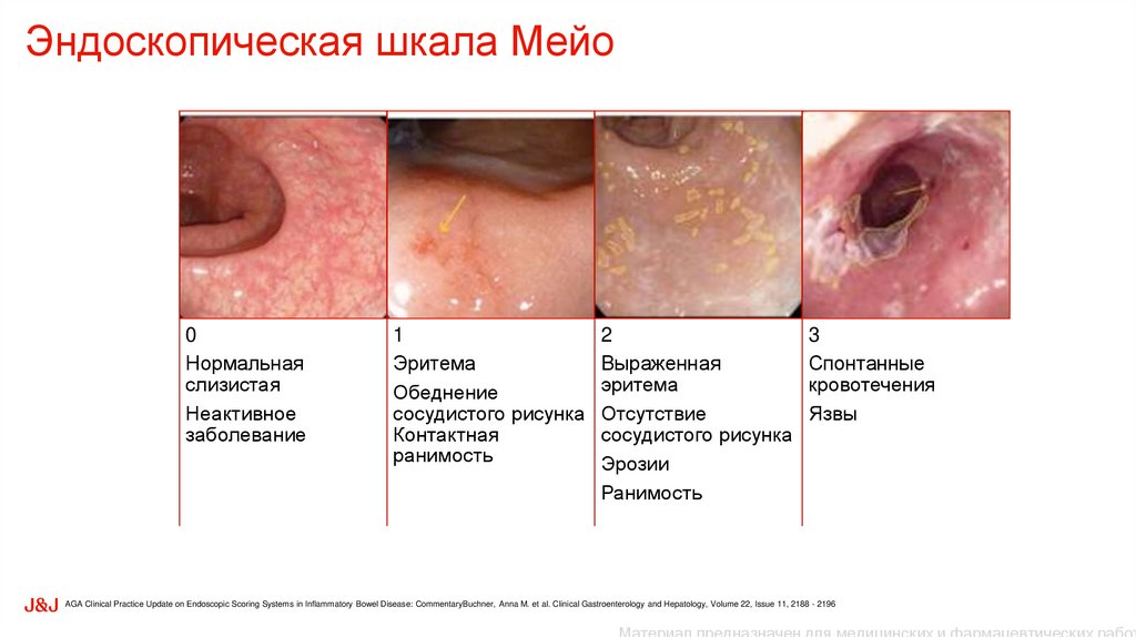 Эндоскопическая шкала Мейо