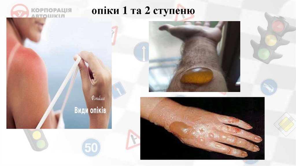 опіки 1 та 2 ступеню