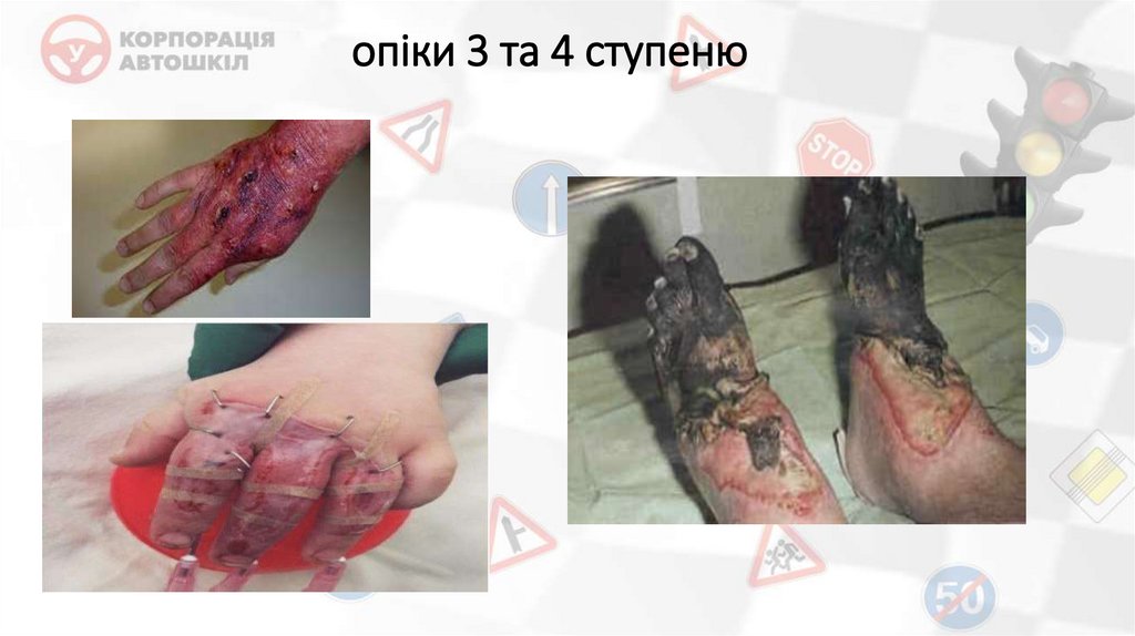 опіки 3 та 4 ступеню