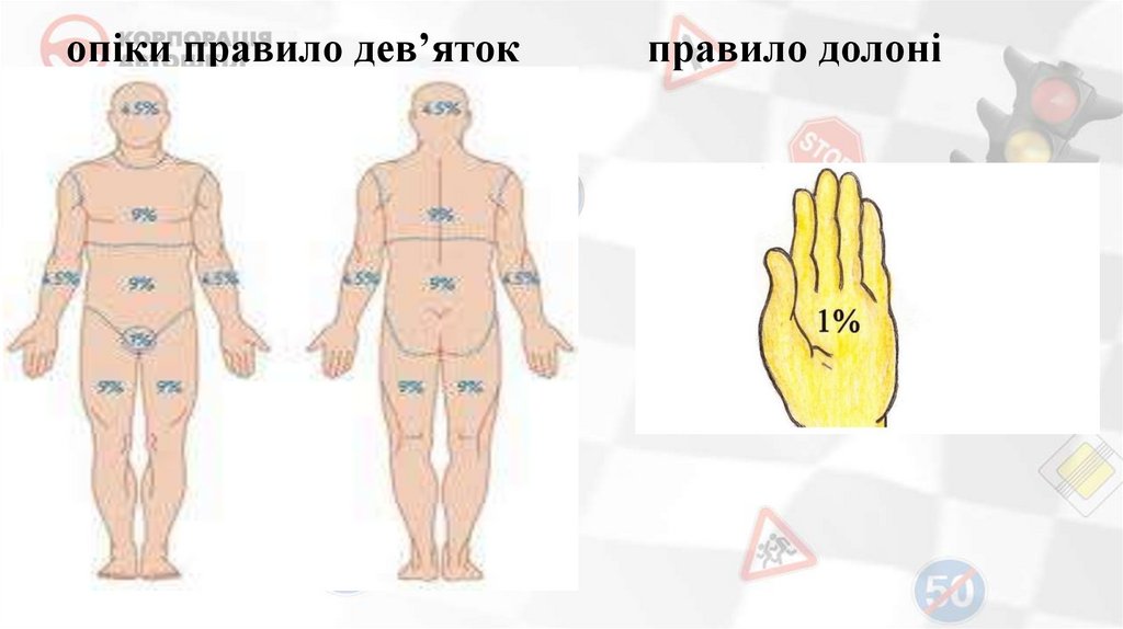 опіки правило дев’яток правило долоні