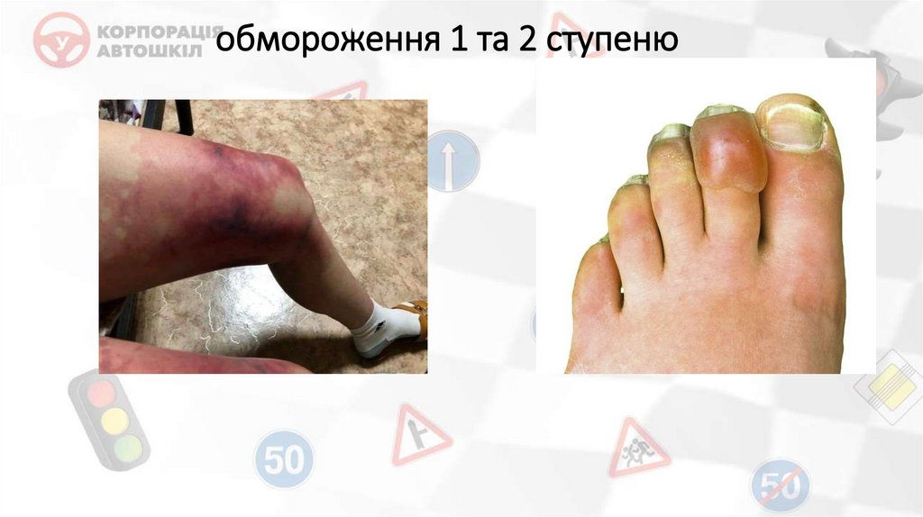 обмороження 1 та 2 ступеню