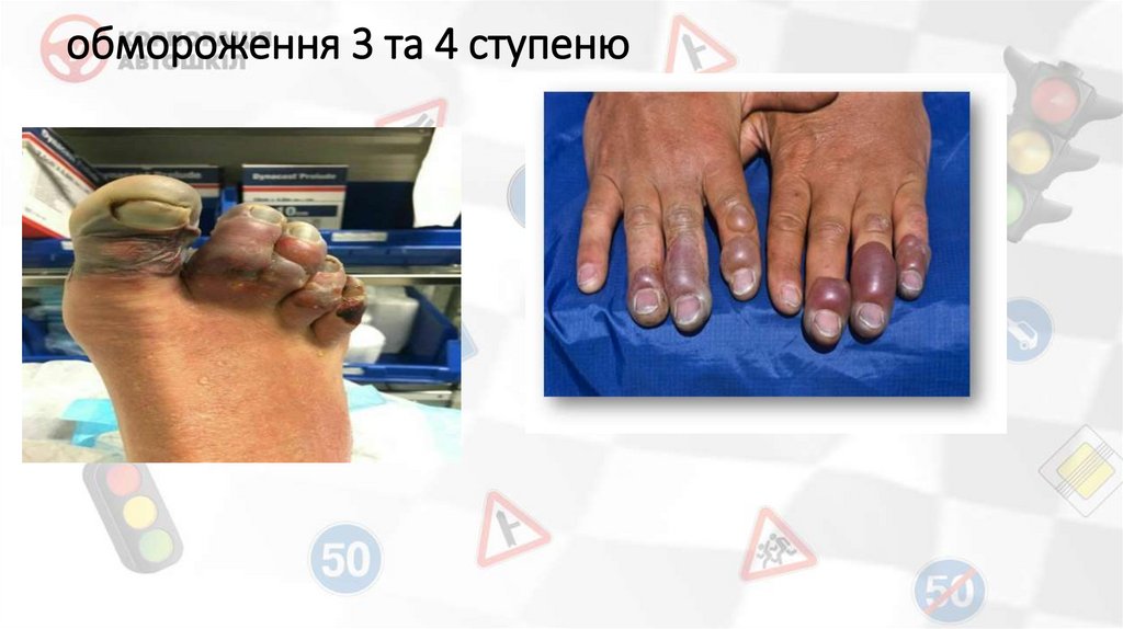 обмороження 3 та 4 ступеню