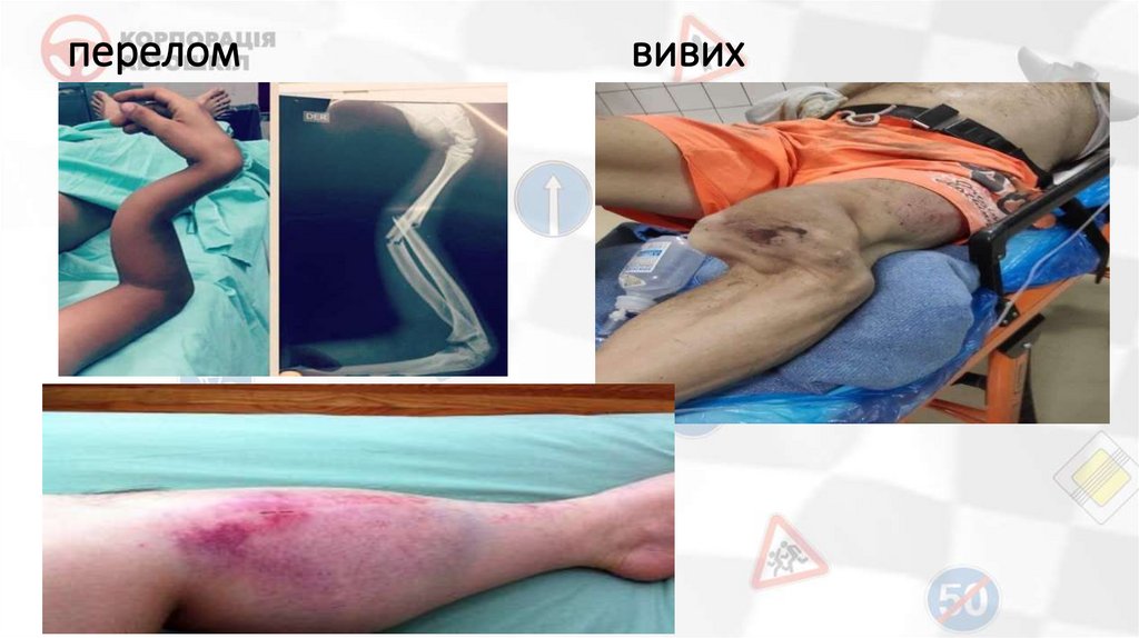 перелом вивих