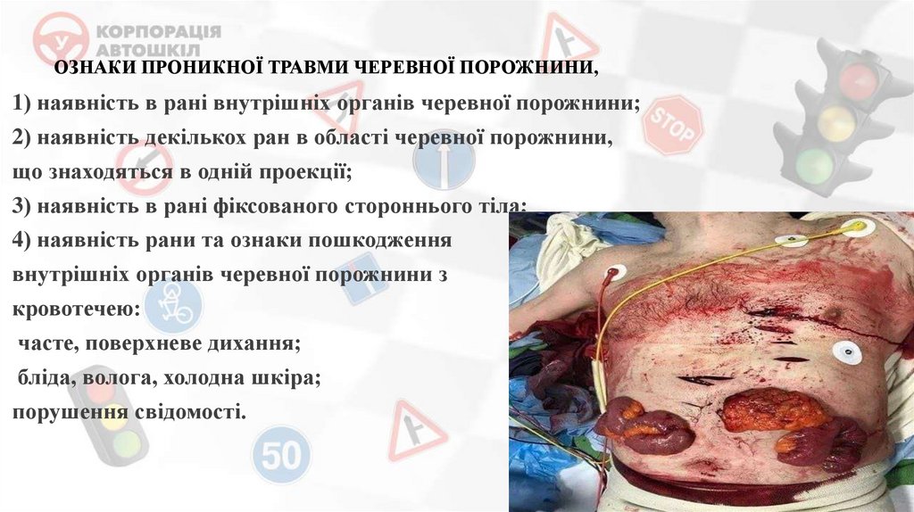 ОЗНАКИ ПРОНИКНОЇ ТРАВМИ ЧЕРЕВНОЇ ПОРОЖНИНИ,