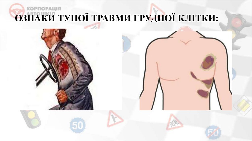 ОЗНАКИ ТУПОЇ ТРАВМИ ГРУДНОЇ КЛІТКИ:
