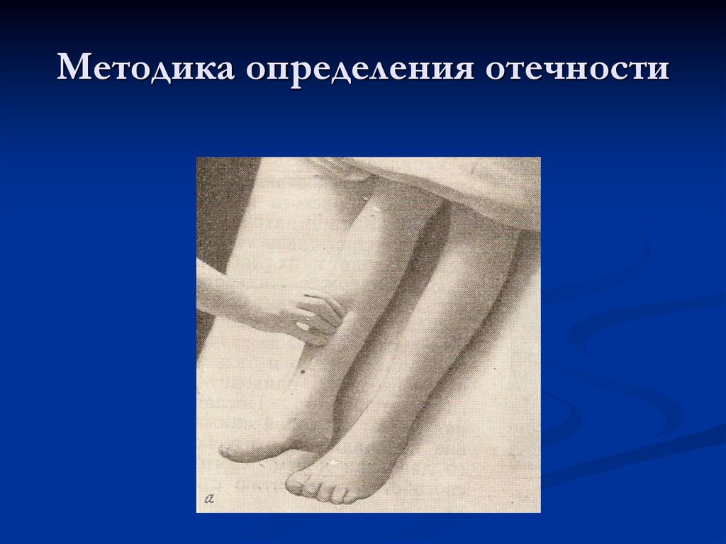 Методика определения отечности