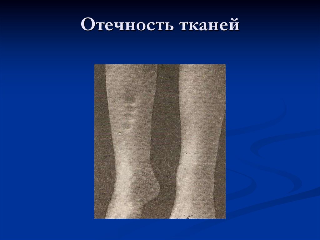 Отечность тканей