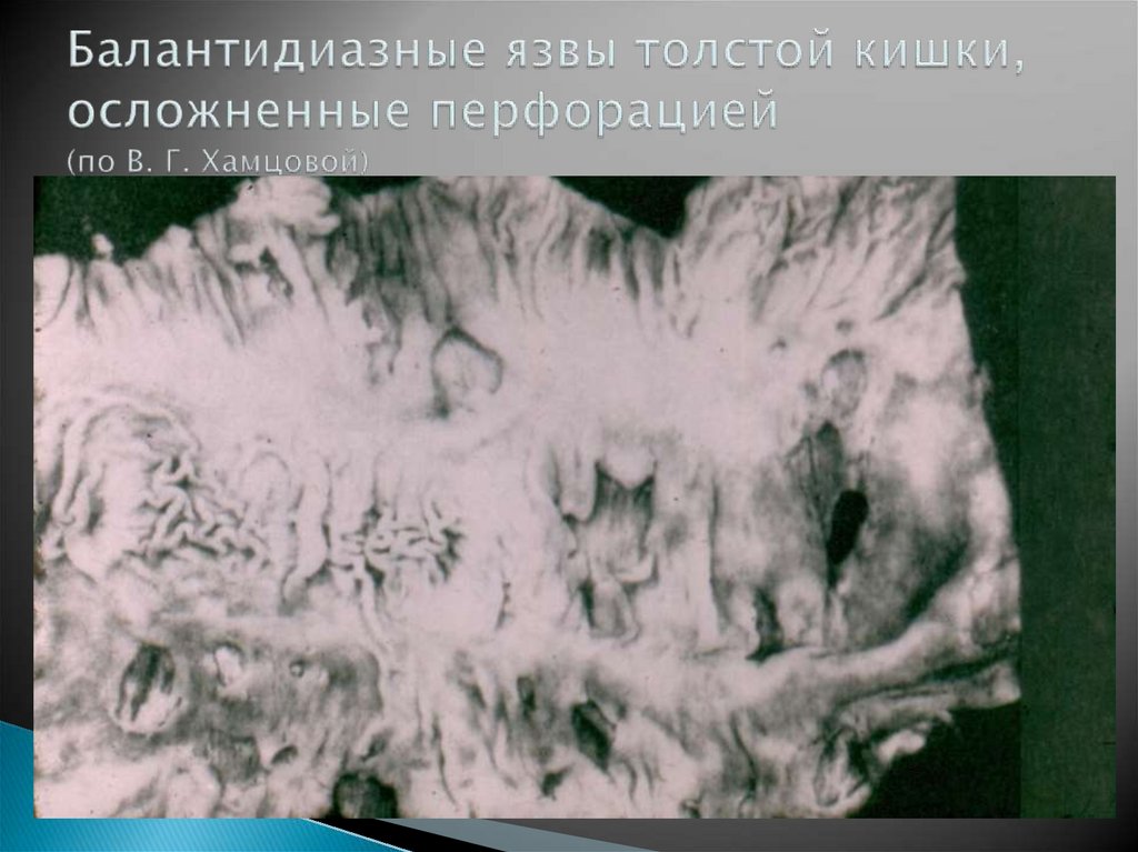 Балантидиазные язвы толстой кишки, осложненные перфорацией (по В. Г. Хамцовой)