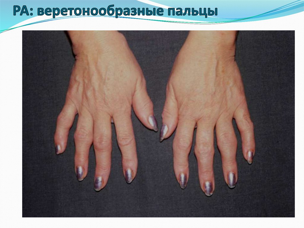 РА: веретонообразные пальцы