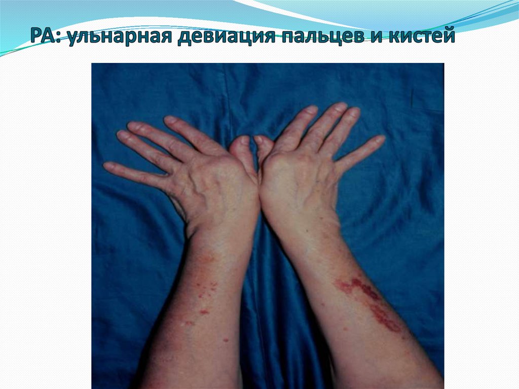 РА: ульнарная девиация пальцев и кистей