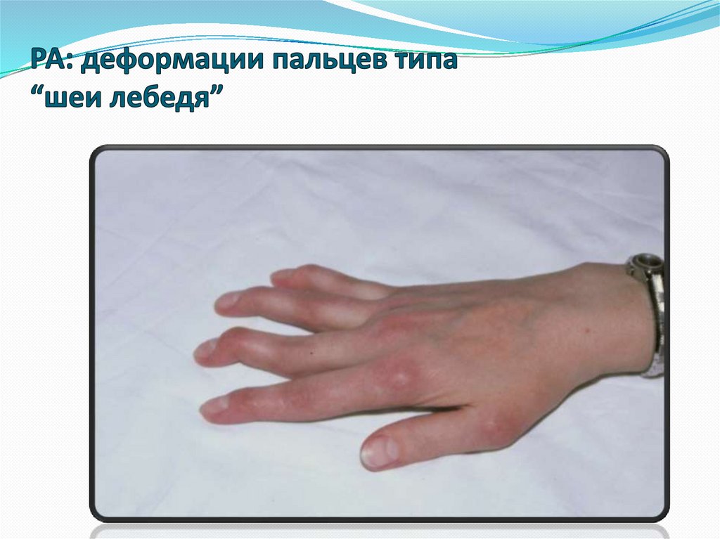 РА: деформации пальцев типа “шеи лебедя”