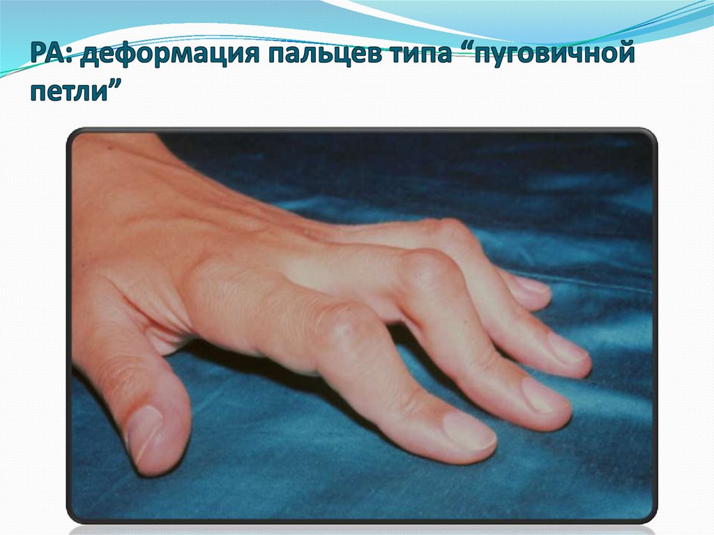 РА: деформация пальцев типа “пуговичной петли”