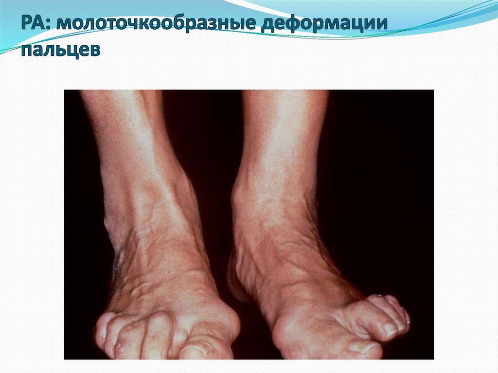 РА: молоточкообразные деформации пальцев