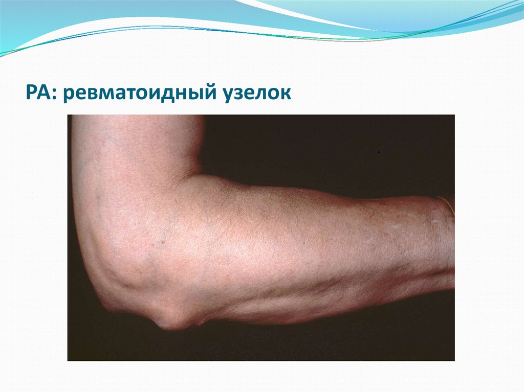 РА: ревматоидный узелок