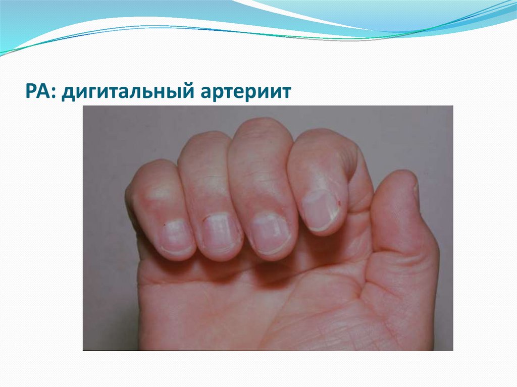 РА: дигитальный артериит