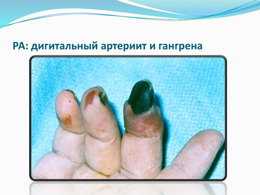 РА: дигитальный артериит и гангрена