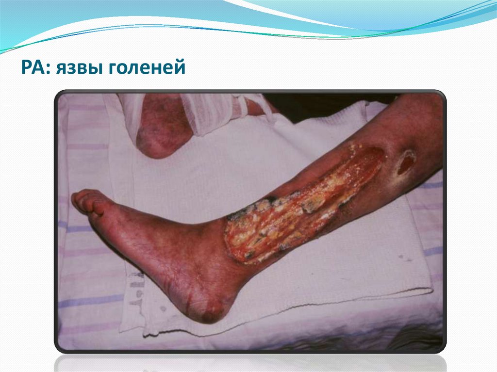 РА: язвы голеней