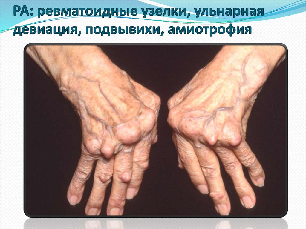 РА: ревматоидные узелки, ульнарная девиация, подвывихи, амиотрофия