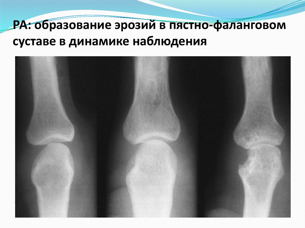 РА: образование эрозий в пястно-фаланговом суставе в динамике наблюдения