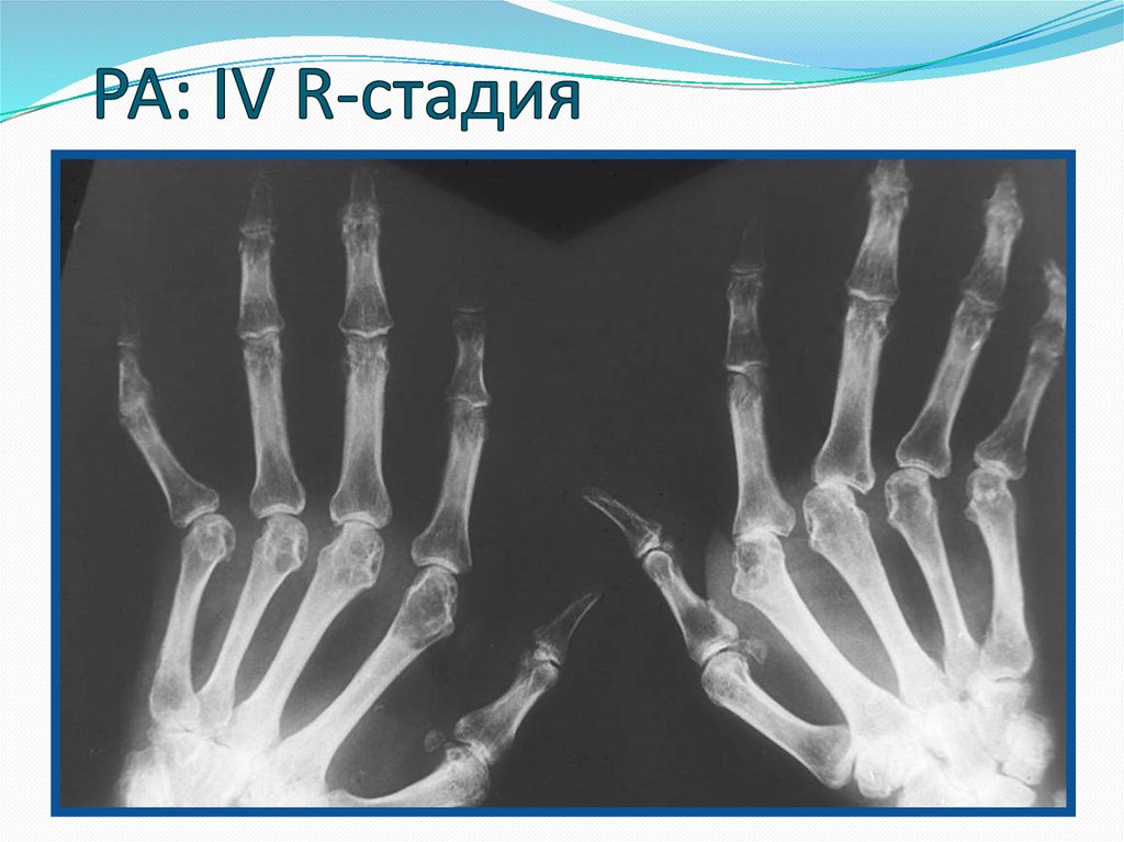 РА: ІV R-стадия