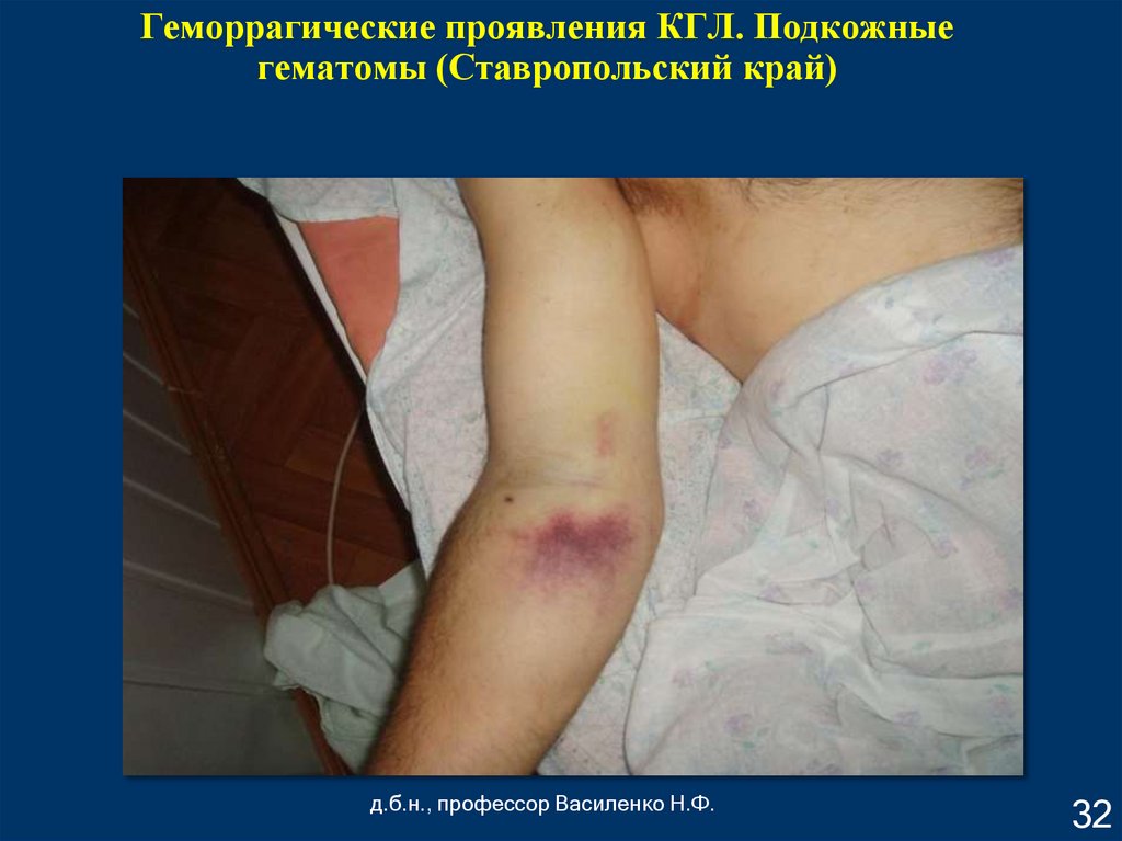 Геморрагические проявления КГЛ. Подкожные гематомы (Ставропольский край)
