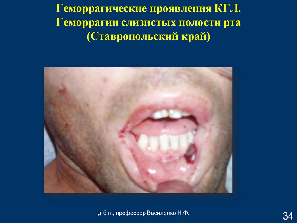 Геморрагические проявления КГЛ. Геморрагии слизистых полости рта (Ставропольский край)