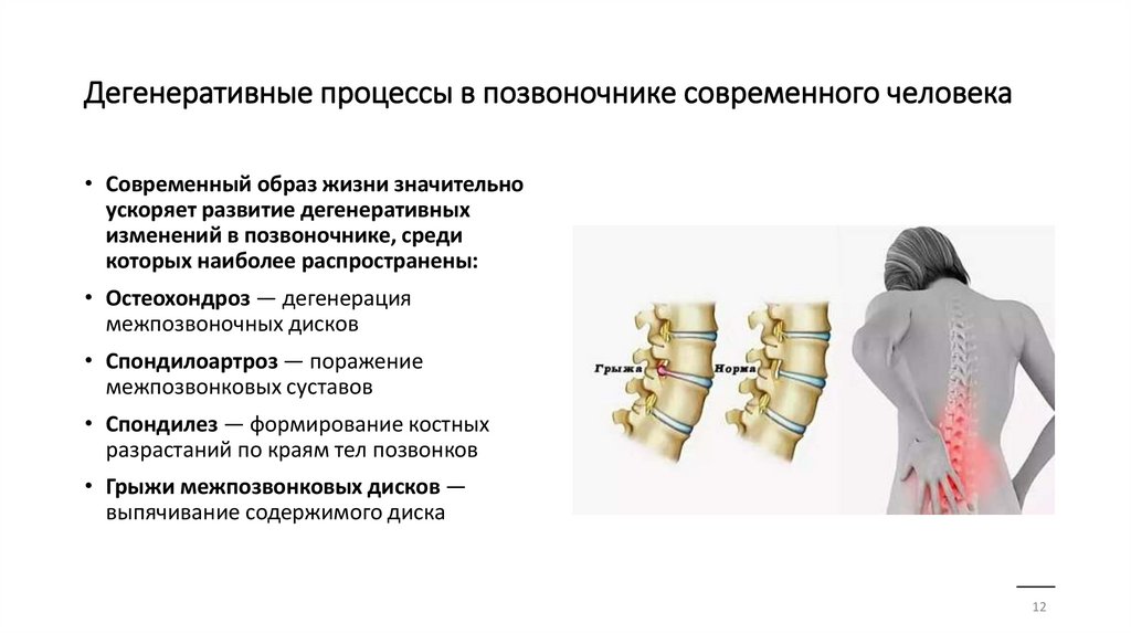 Дегенеративные процессы в позвоночнике современного человека