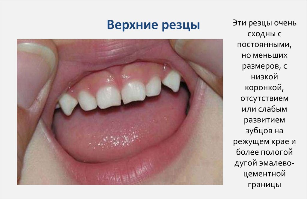 Верхние резцы