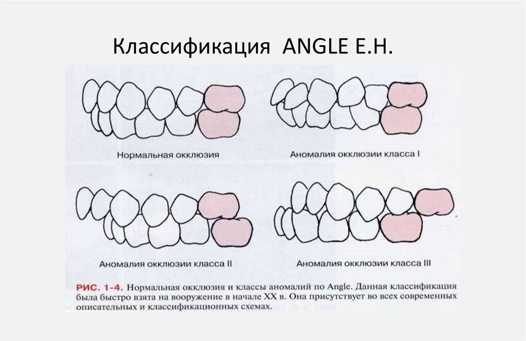 Классификация ANGLE E.H.