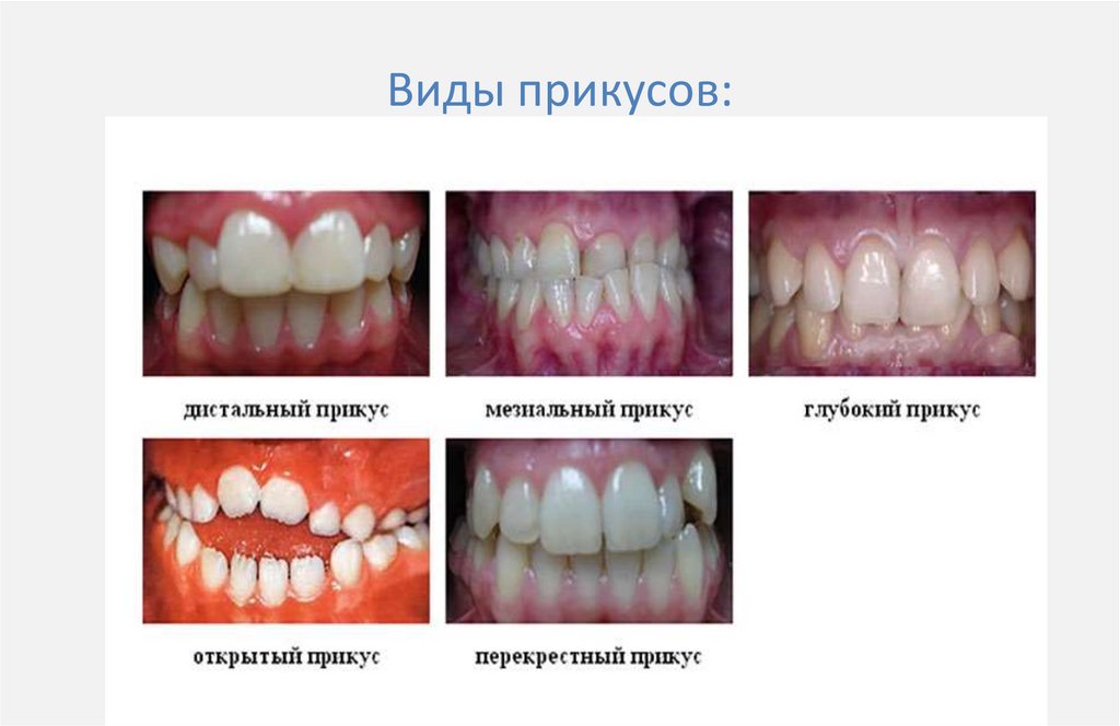 Виды прикусов: