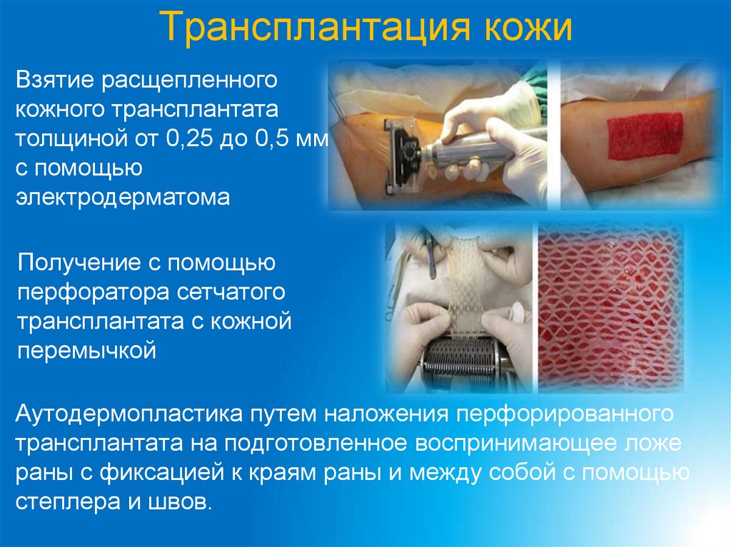 Трансплантация кожи