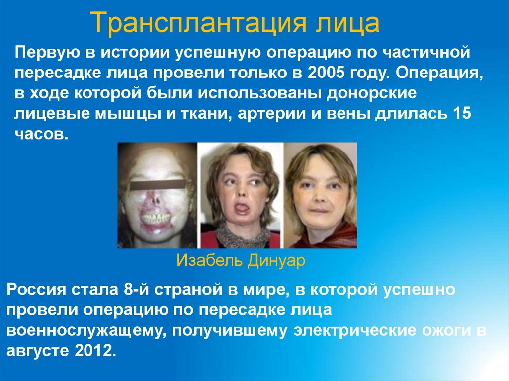 Трансплантация лица